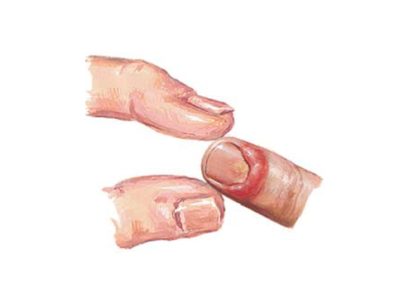 Paronychia-1