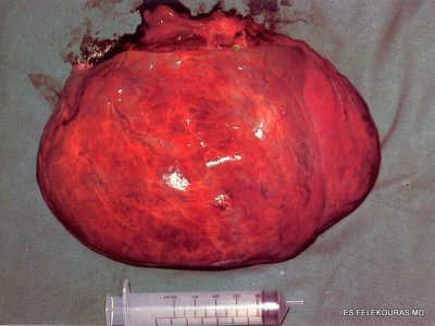 cystadenoma-header