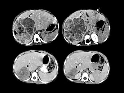 hepatoblastoma-header