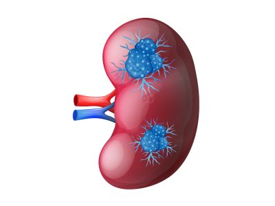 kidney-cancer